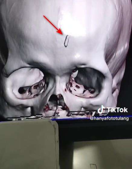 Hasil ct scan perlihatkan benda aneh di kepala pasien.