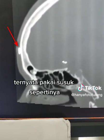 Hasil ct scan perlihatkan benda aneh di kepala pasien.