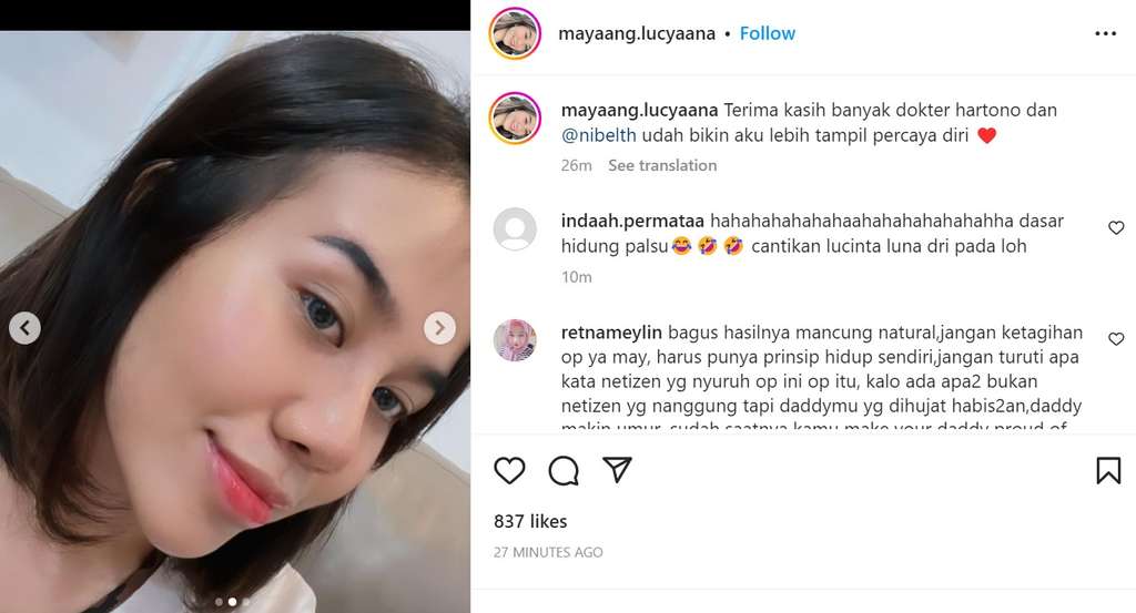 Penampakan hidung Mayang usai operasi