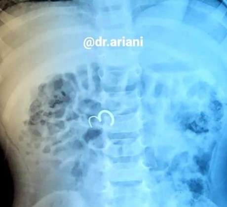 Anting
