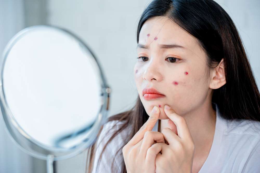 3 Kebiasaan Sepele yang Ternyata Bisa Bikin Jerawat Makin Parah, Apa Saja?