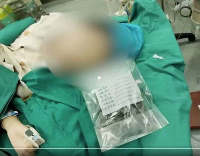 Dokter Temukan 1 Kg Gumpalan Rambut dalam Perut Gadis 9 Tahun