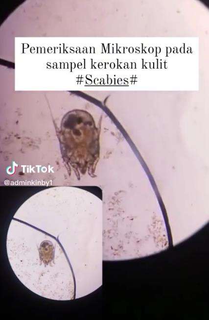 Penampakan tungau penyebab kudis dilihat dengan mikroskop.