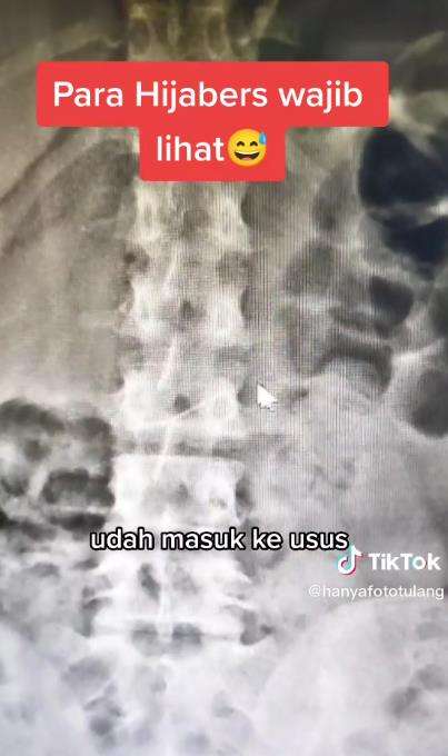 Kebiasaan buruk jepit jarum pentul pakai mulut.