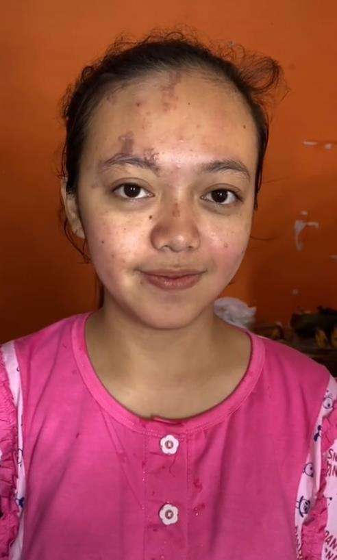Transformasi wajah pengantin penuh luka jadi mulus dan flawless.
