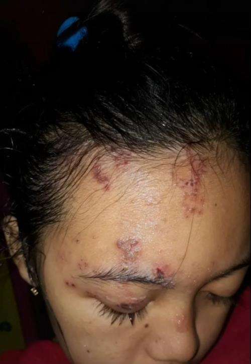 Transformasi wajah pengantin penuh luka jadi mulus dan flawless.