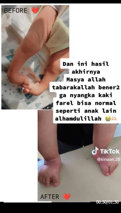 Kisah Haru Perjuangan Orangtua Demi Kaki Anaknya Normal, Masya Allah! Bikin Warganet Mewek