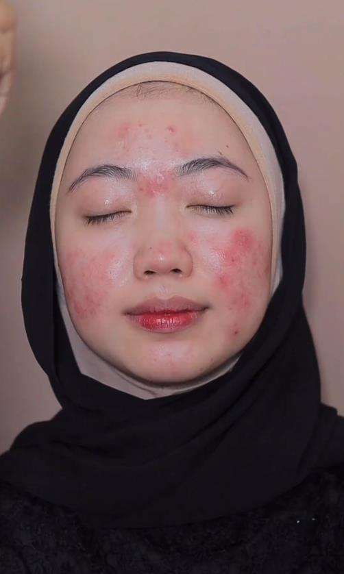 Transformasi wajah pengantin penuh luka jadi mulus dan flawless.