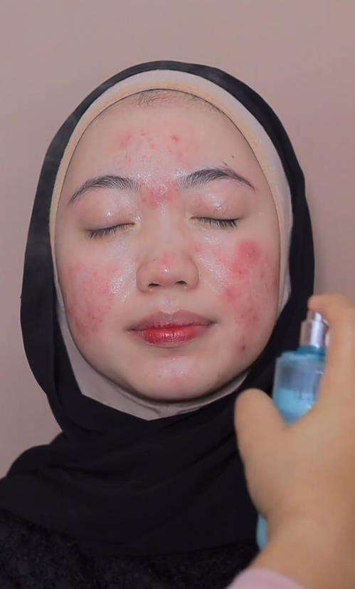 Transformsi wajah berjerawat parah jadi natural dan flawless.