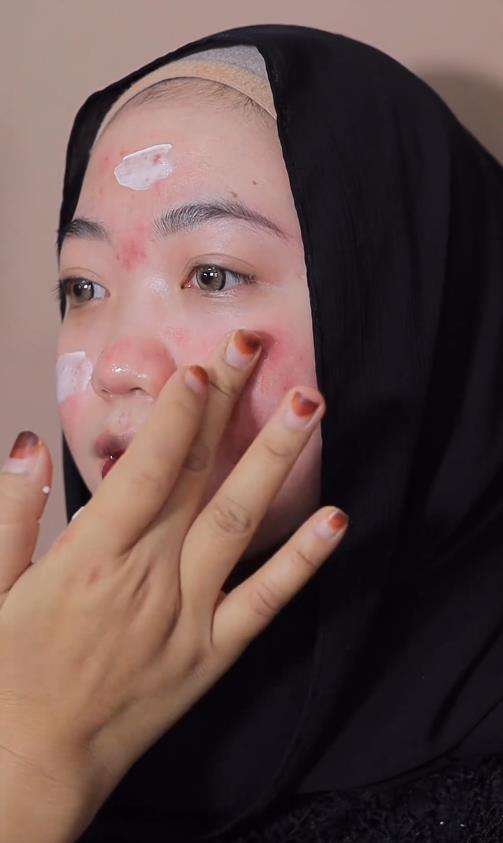 Transformasi wajah berjerawat parah jadi natural dan flawless.