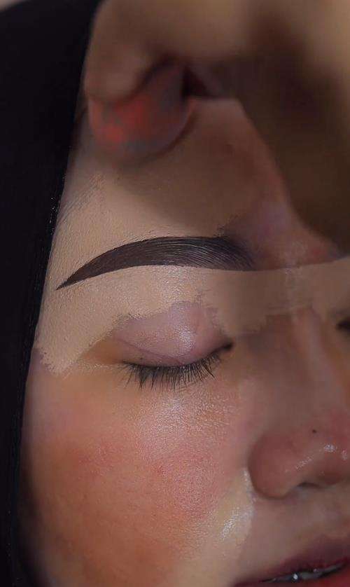 Transformasi wajah berjerawat parah jadi natural dan flawless.