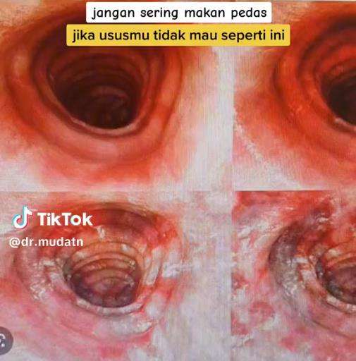 Kondisi usus pasien yang sering makan pedas.
