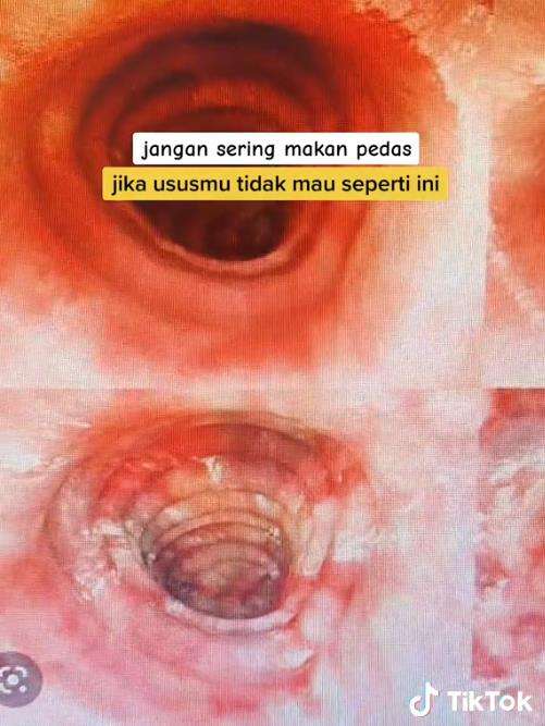 Kondisi usus pasien yang sering makan pedas.