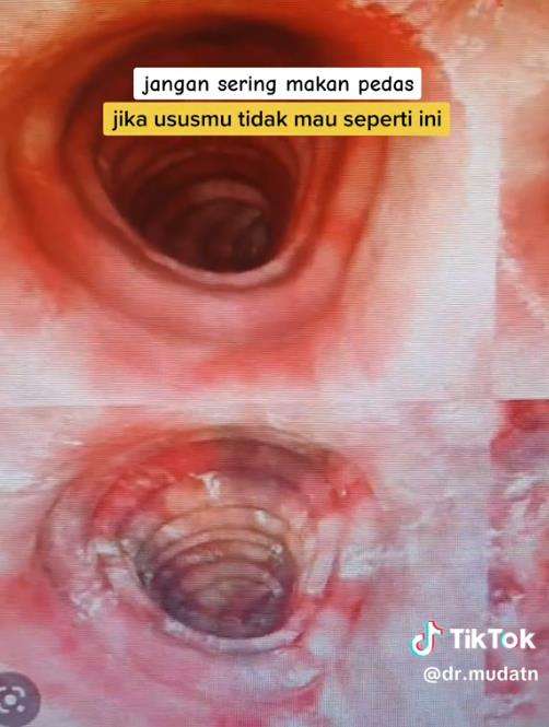 Kondisi usus pasien yang sering makan pedas.