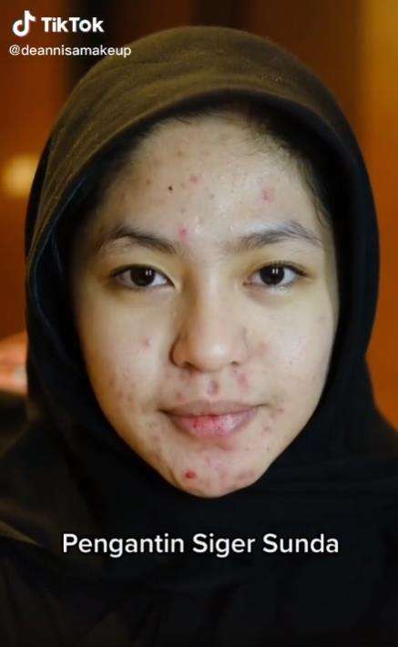 Transformasi makeup pengantin siger Sunda penuh jerawat.