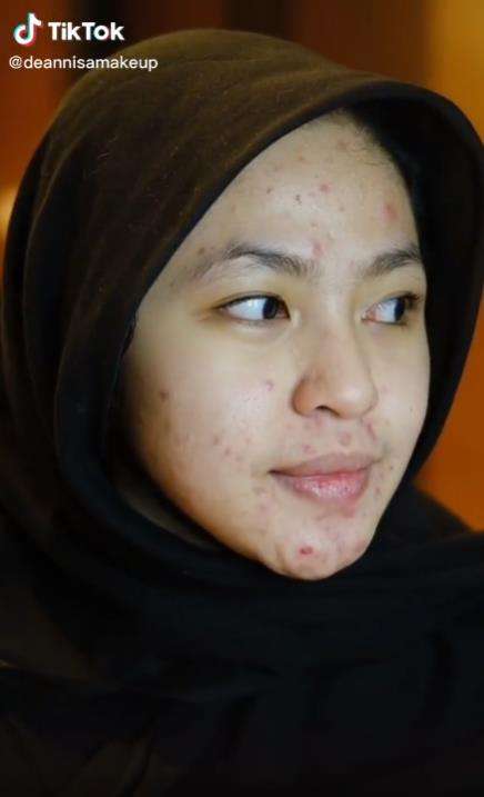 Transformasi makeup pengantin siger Sunda penuh jerawat.