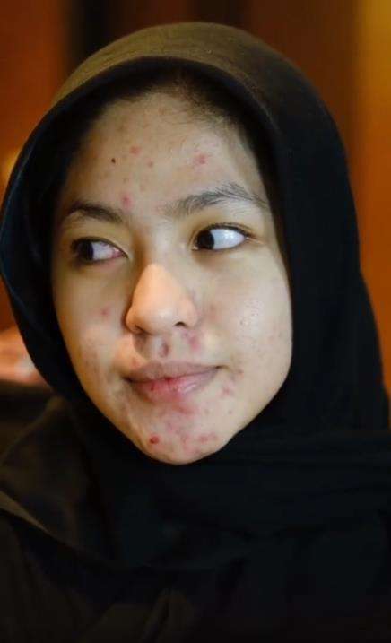 Transformasi makeup pengantin siger Sunda penuh jerawat.