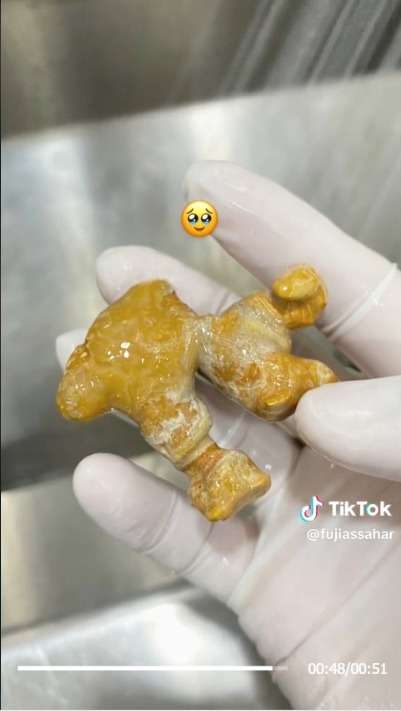 Awalnya Sakit Pinggang Ternyata Ada Batu Ginjal Sebesar Jahe di Tubuh Pasien Wanita, ini Penyebabnya