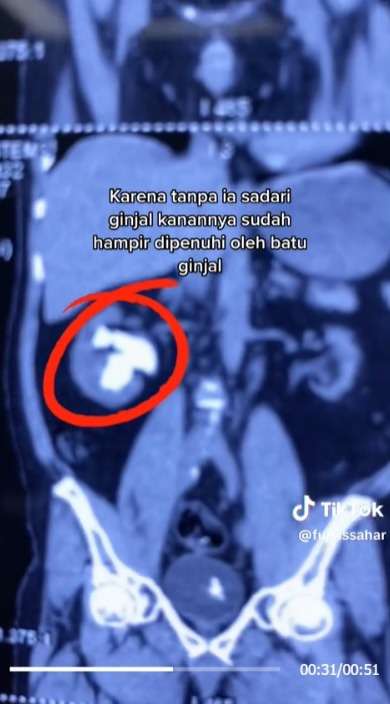 Awalnya Sakit Pinggang Ternyata Ada Batu Ginjal Sebesar Jahe di Tubuh Pasien Wanita, ini Penyebabnya