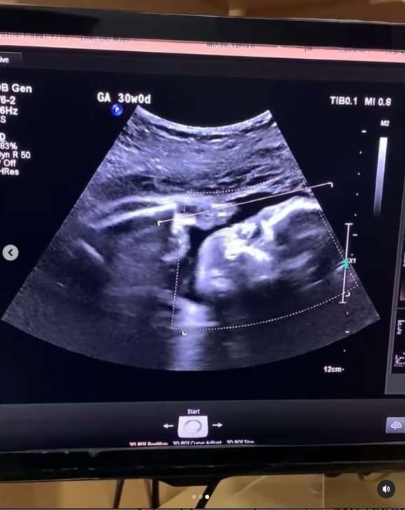 Calon Ibu Menangis Bahagia Melihat Anak di Kandungannya Dadah Saat Periksa USG, Sempat Dibilang Sudah Mati oleh Mertuanya