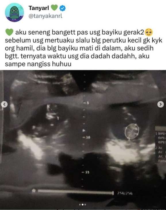 Calon Ibu Menangis Bahagia Melihat Anak di Kandungannya Dadah Saat Periksa USG, Sempat Dibilang Sudah Mati oleh Mertuanya