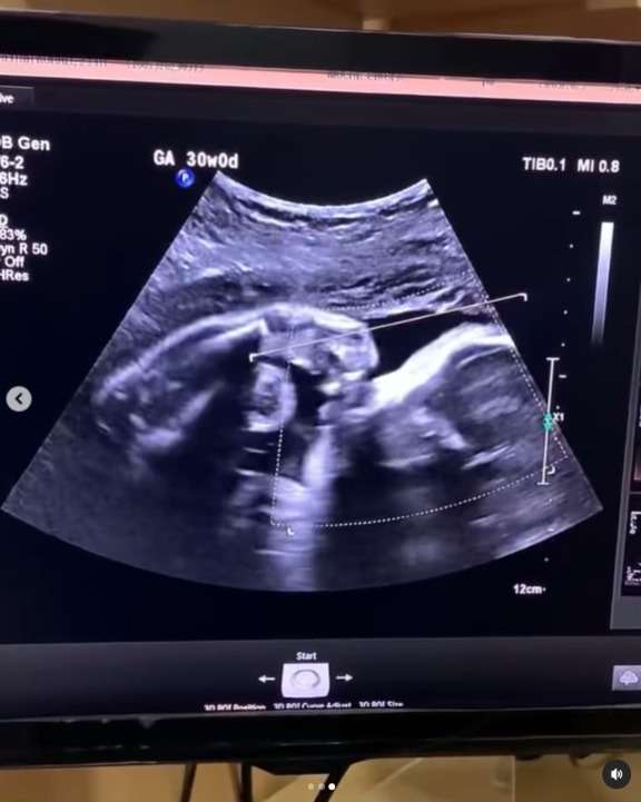 Calon Ibu Menangis Bahagia Melihat Anak di Kandungannya Dadah Saat Periksa USG, Sempat Dibilang Sudah Mati oleh Mertuanya
