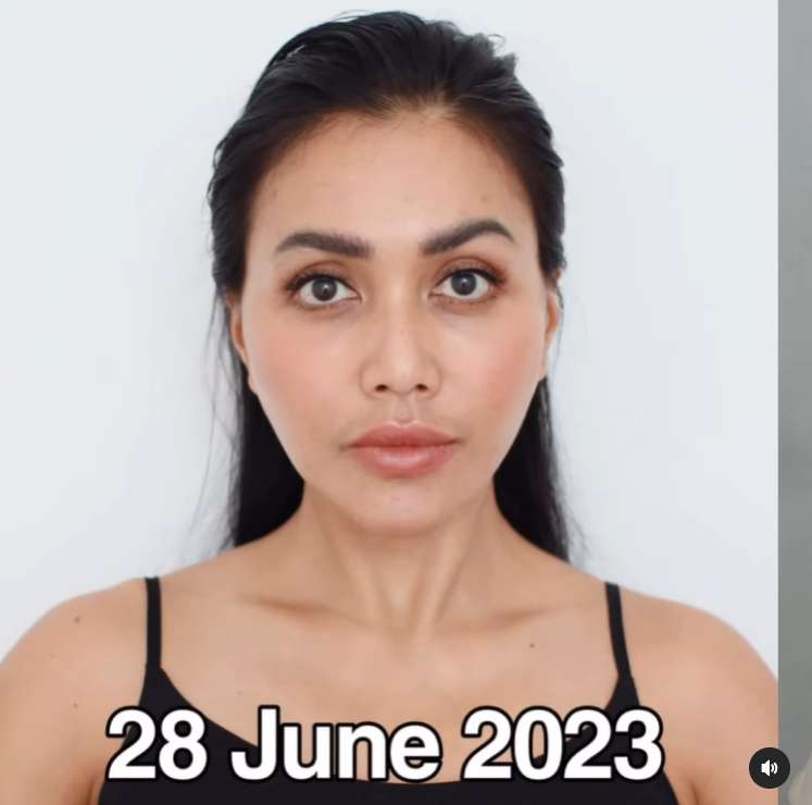 Penampilan Denada sesudah tindakan