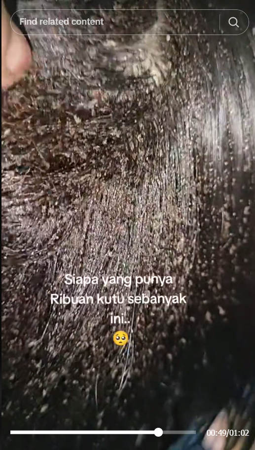 Merinding! Awalnya Dikira Ketombe, Ternyata ada Ribuan Kutu Bersarang di Kepala Wanita ini