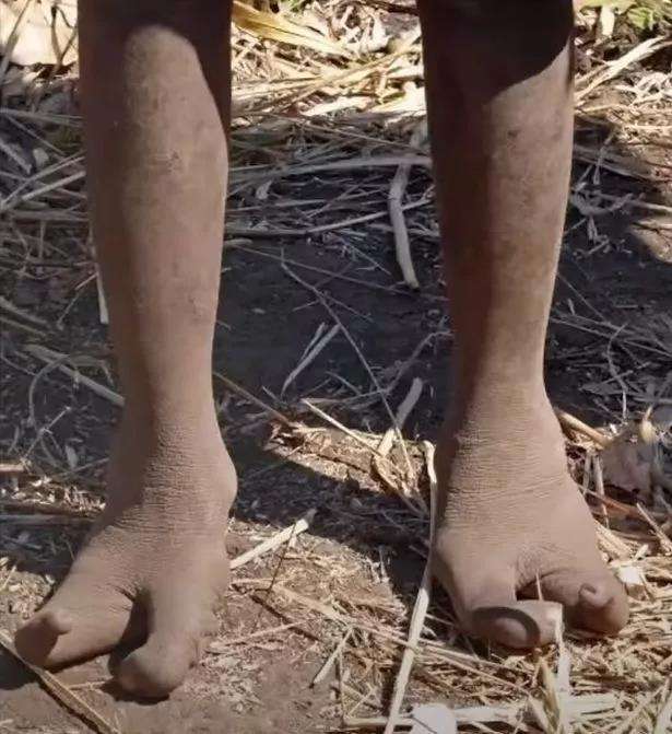 Suku di Afrika dilahirkan dengan kaki mirip burung unta.