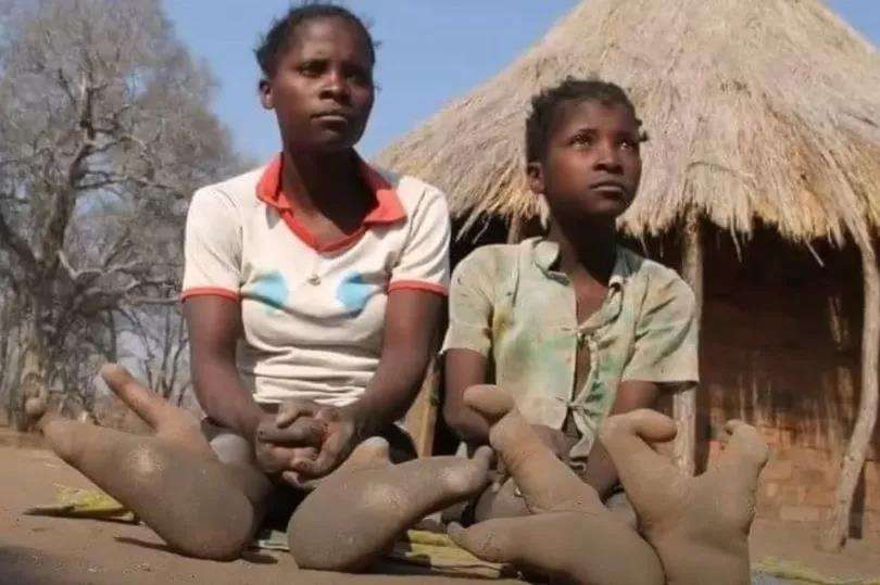 Suku di Afrika dilahirkan dengan kaki mirip burung unta.