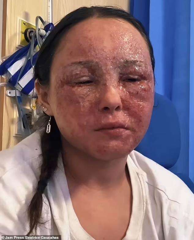Gadis cantik idap eksim parah, kulitnya seperti kena luka bakar.