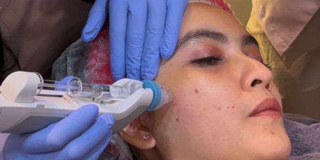 Leny Skincare Perkenalkan REMEE Pro Injector: Teknologi Canggih untuk Skinbooster Minim Rasa Sakit