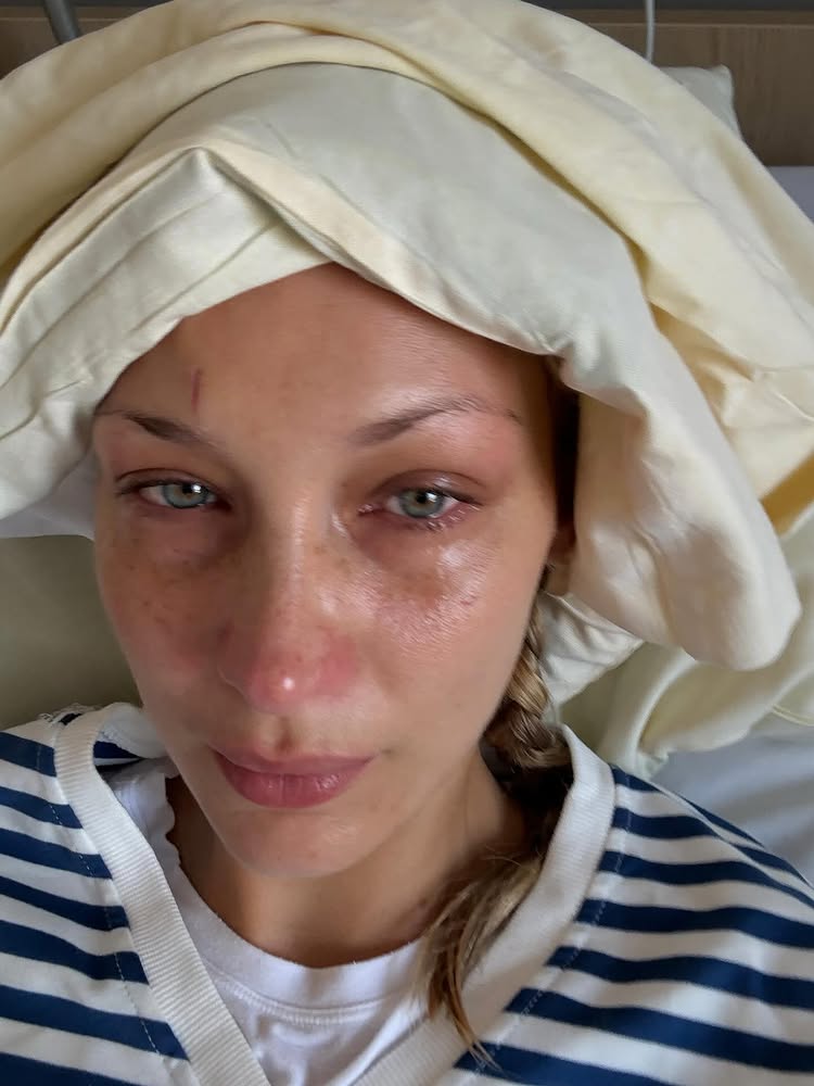 Bella Hadid sakit lyme diseases