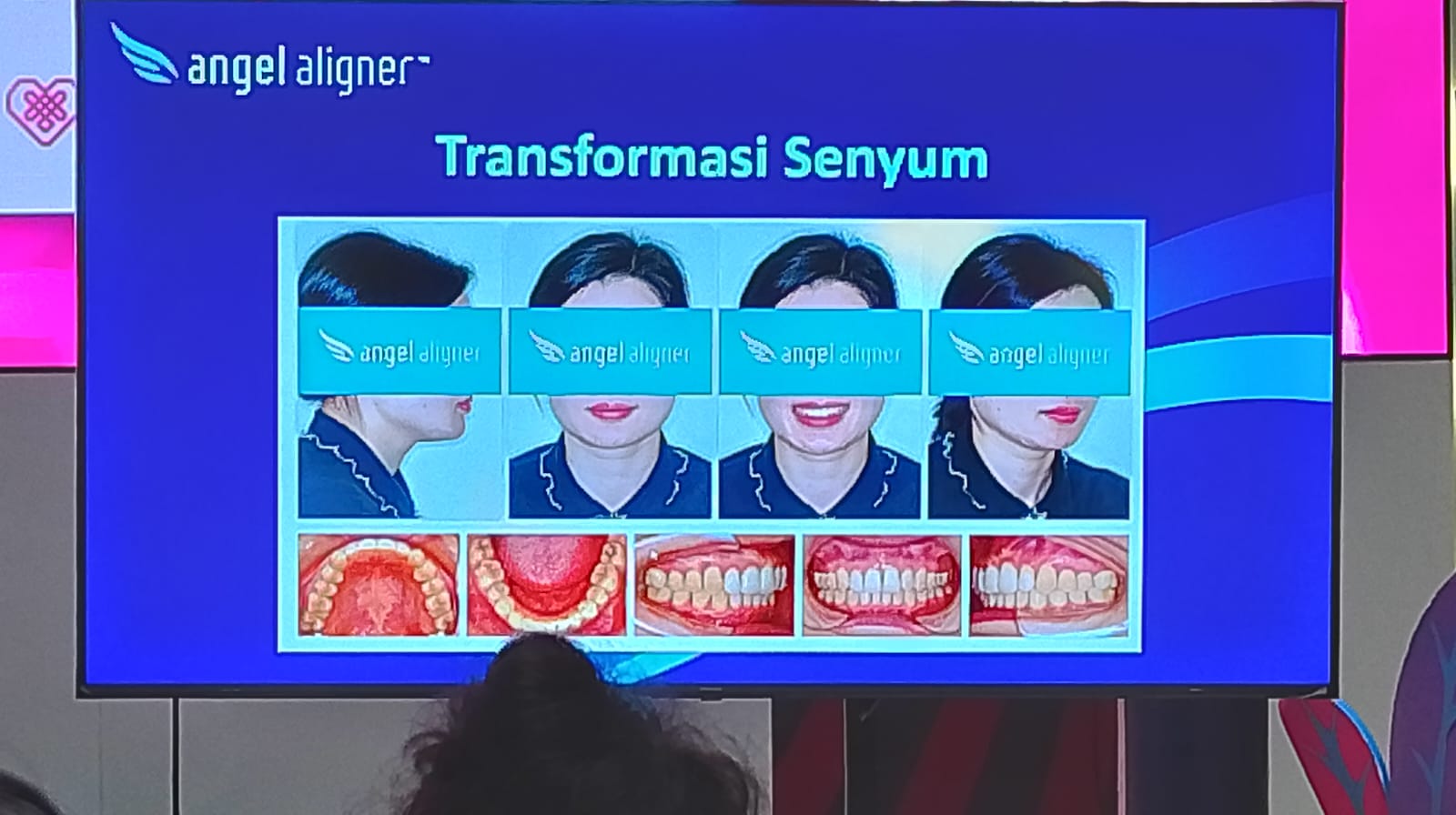Angel Aligner