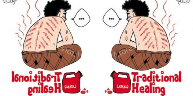 Mengenal `Kerokan` di Berbagai Negara