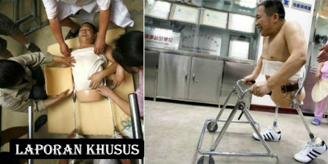 Inspiratif (4): Kisah Peng Shuilin, Pebisnis Bertubuh Separuh