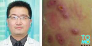 Gatal Tak Tertahan, Ternyata Tubuh Pria Ini Dipenuhi Belatung