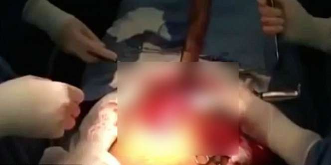 Mengerikan, Belut Sepanjang 125 Cm Hidup di Perut Pria Ini