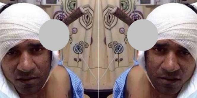 Ajaib, Tetap Hidup Meski Pisau Menancap di Kepala