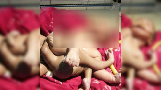 Geger `Bayi Dewa`, Punya 4 Kaki dan 4 Tangan