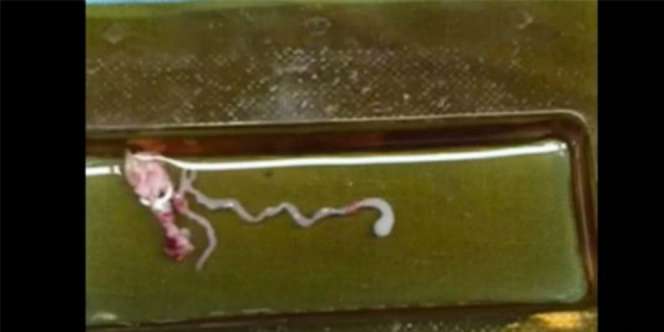 Santap Makanan Kurang Matang, Cacing Bersarang di Otak