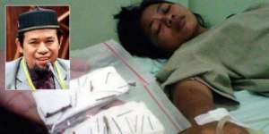 2.000 Paku Misterius Dikeluarkan dari Tubuh Perempuan Sumatra