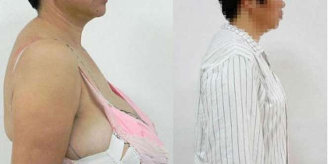 Kisah Penderita Gigantomastis 