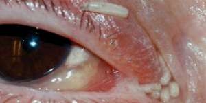 120 Belatung Hidup di Dalam Hidung dan Mata Wanita Ini