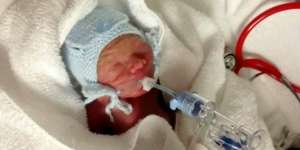 Keajaiban Bayi yang Lahir di Usia Kandungan 5 Bulan