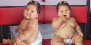 Usia Belum Setahun, Bayi Ini Berbobot 20 Kilogram