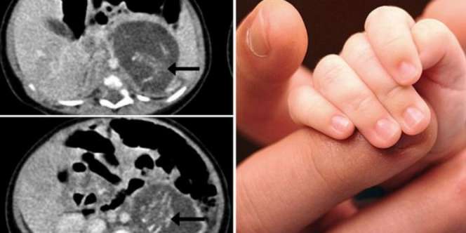 Bayi Lahir Langsung `Hamil` Anak Kembar