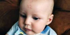 Bayi Ini Punya Tanda Lahir 'Aneh' di Dahi