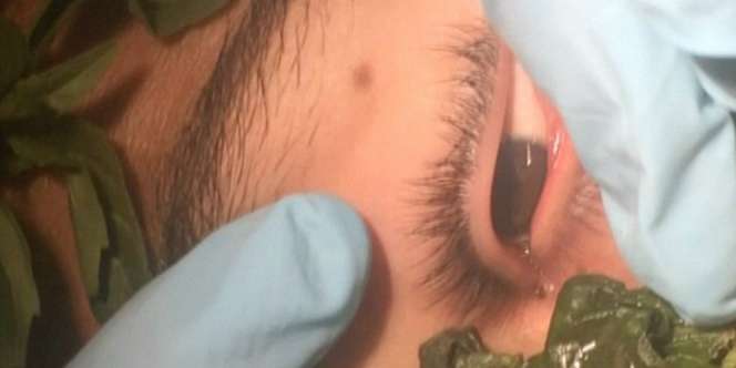Sebulan Bersarang, Cacing Dikeluarkan dari Mata Anak Ini