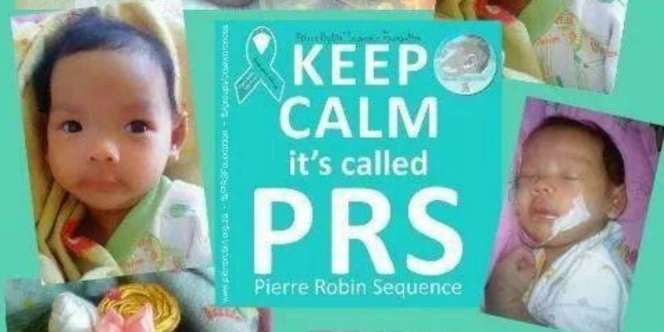 Bidadari Kecilku dan `Pierre Robin Sequence`